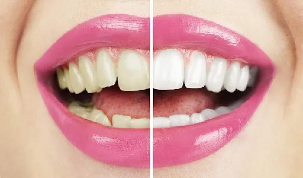 Enhancing Smiles: The Science and Benefits of Teeth Whitening
