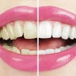 Enhancing Smiles: The Science and Benefits of Teeth Whitening