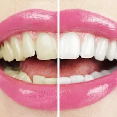 Enhancing Smiles: The Science and Benefits of Teeth Whitening